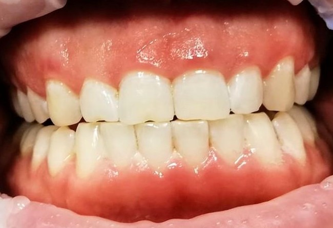 Zęby przed higienizacją