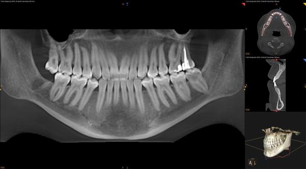 Tomografia CBCT